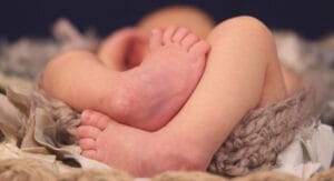 Infant with bilateral clubfoot before Ponseti method serial casting