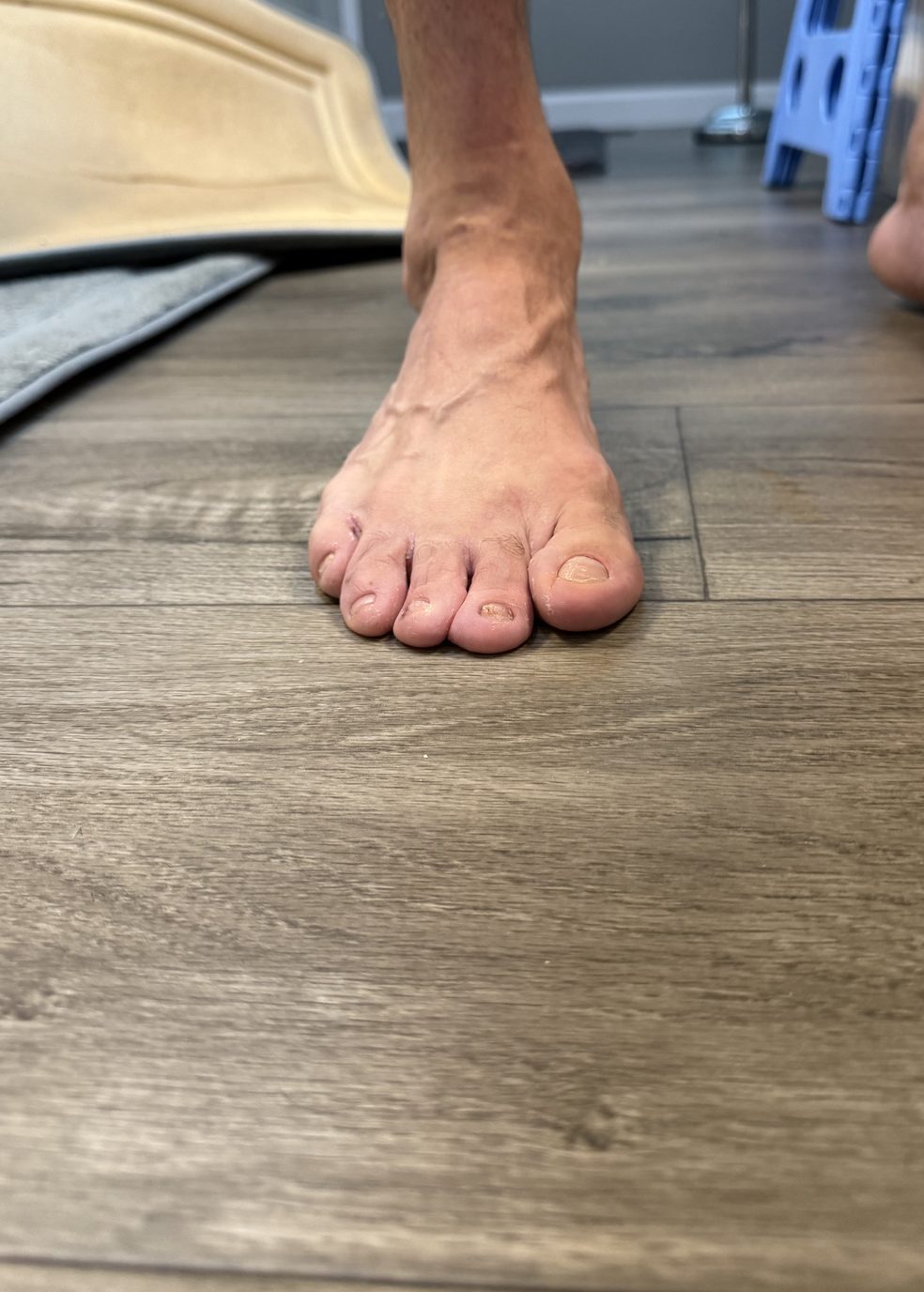 Both feet of an adult with treated bilateral clubfoot, photographed from above while standing barefoot on a wood floor.