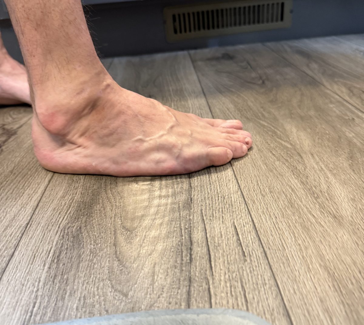 Outer border of the foot of an adult with treated clubfoot, photographed at floor level while standing barefoot.