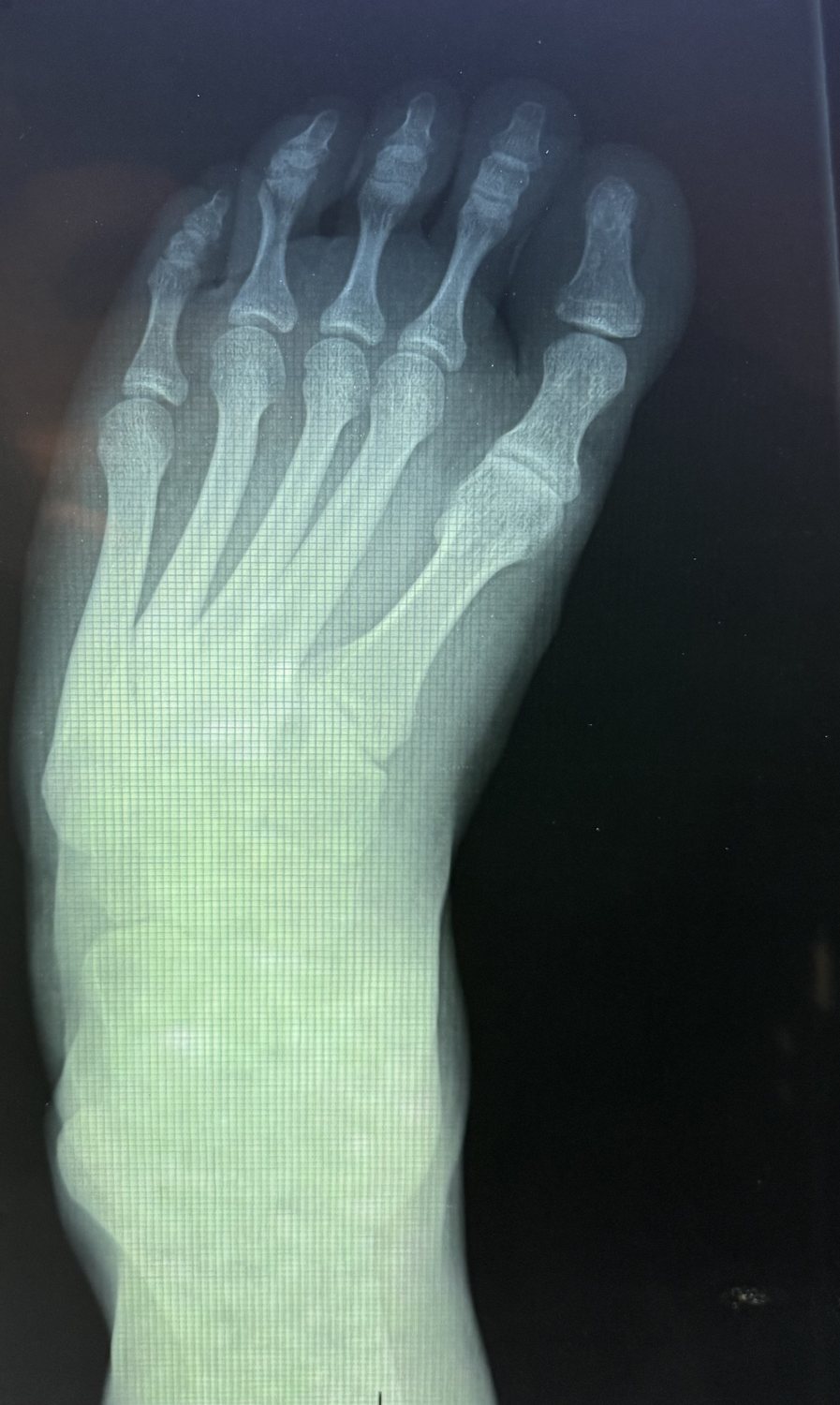 X-ray of the left foot of a sixteen year old with treated clubfoot, taken in March 2001, four months before a triple arthrodesis. Viewed from above, showing the metatarsals and toes.