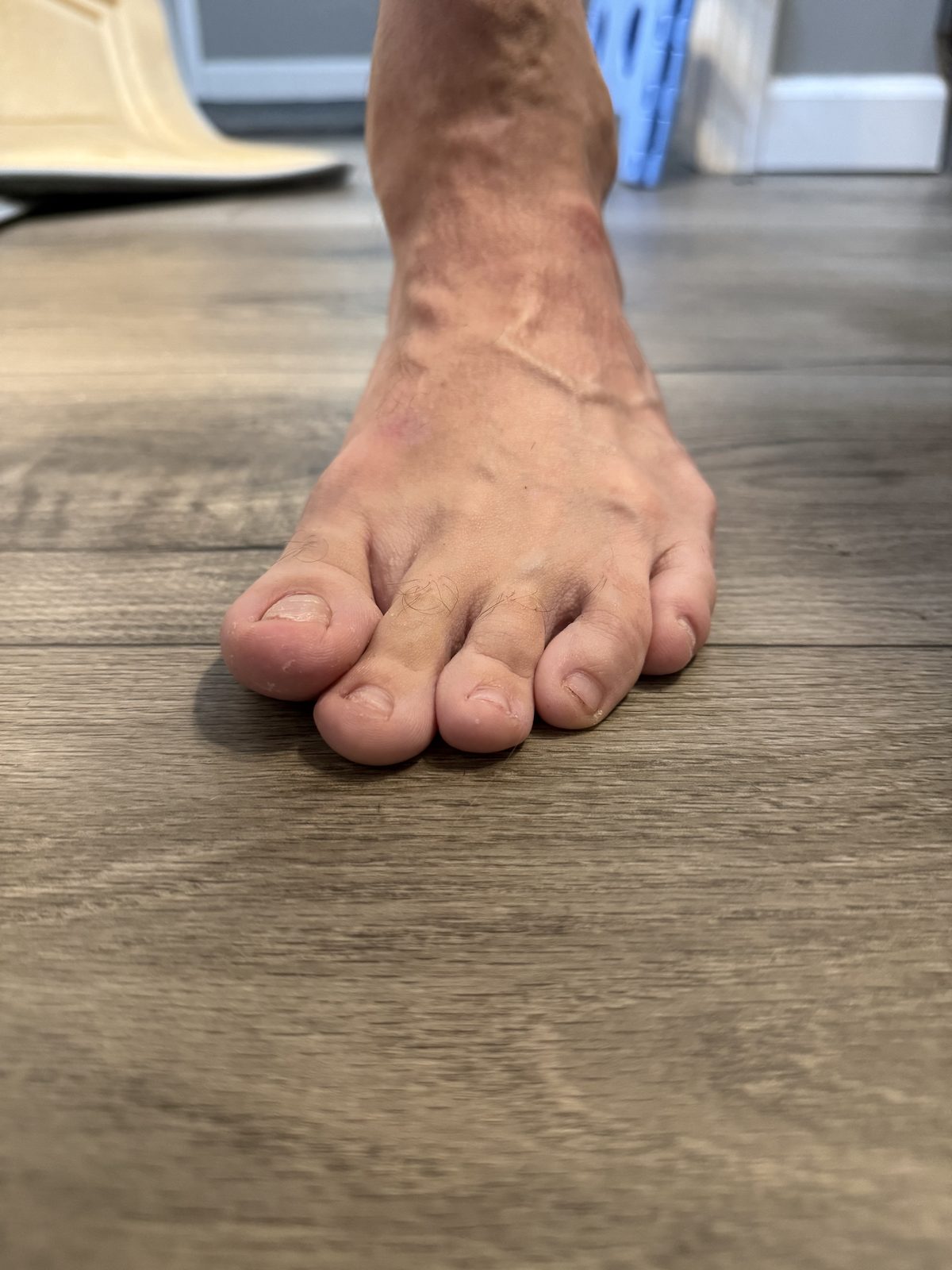 Forefoot and toes of the left foot of an adult with treated clubfoot, photographed from directly above while standing barefoot.