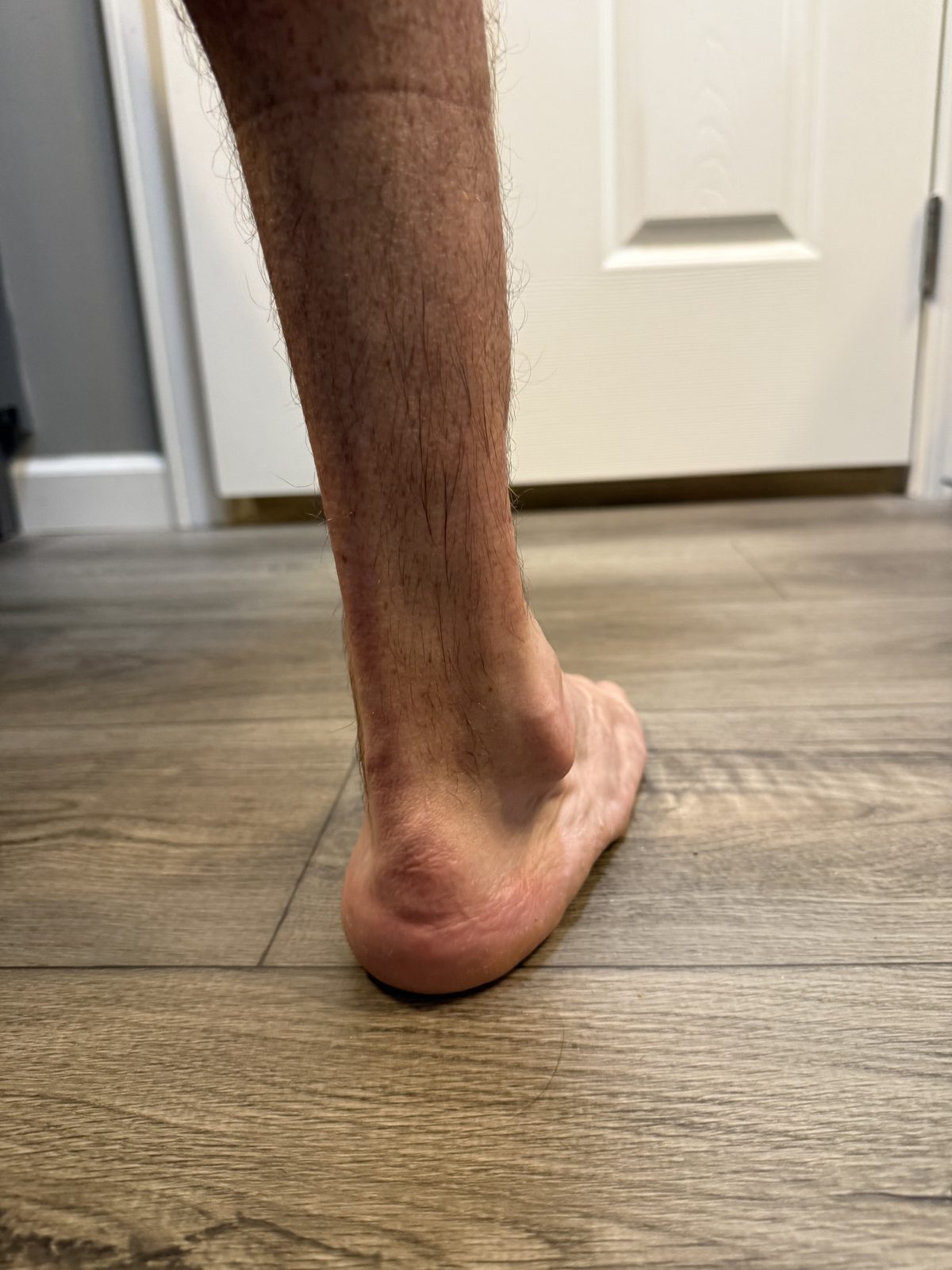 Heel and lower leg of an adult with treated clubfoot photographed from behind, standing barefoot, showing the position the heel sits in under load.