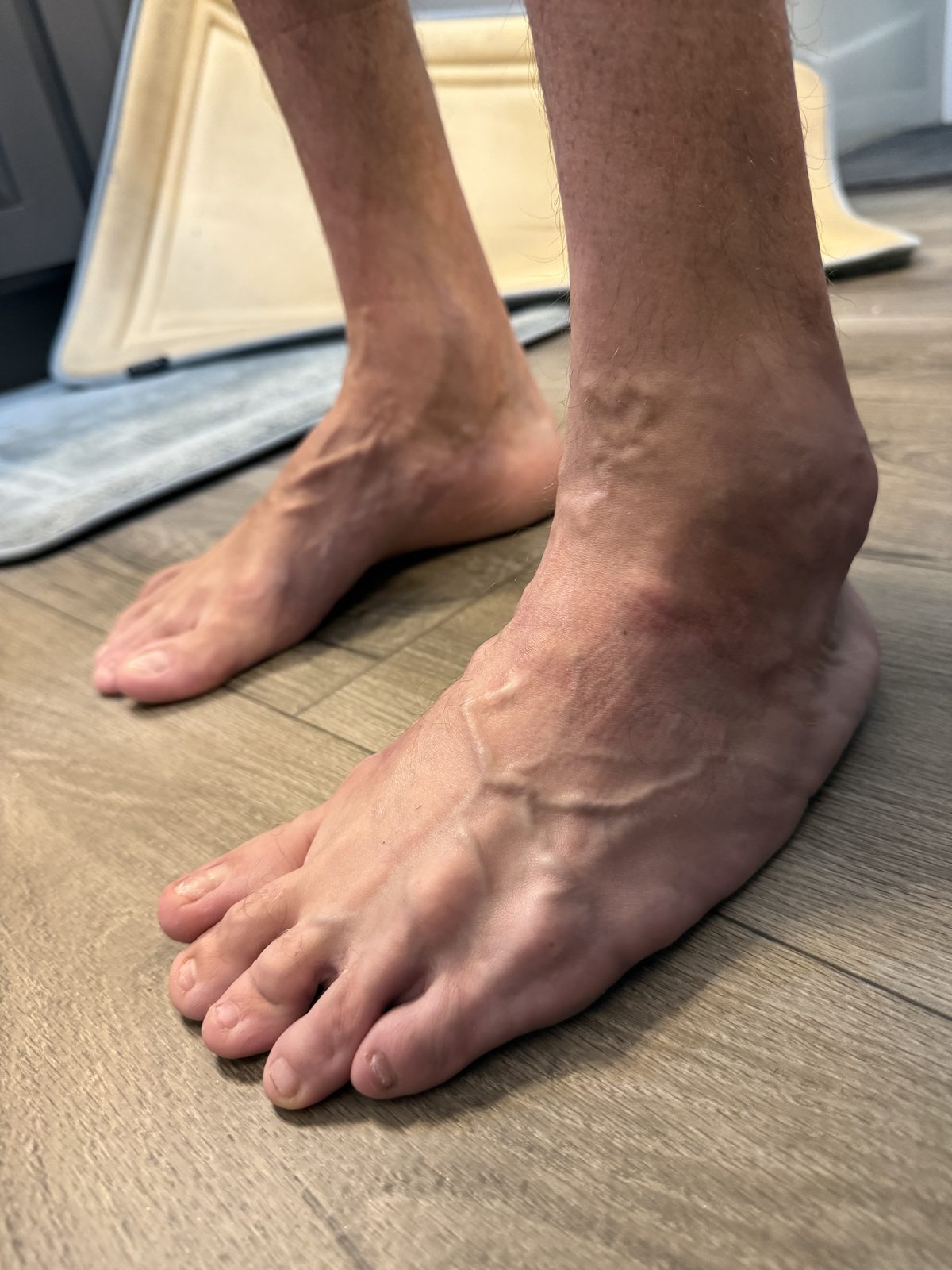 Left foot of an adult with treated bilateral clubfoot, seen from above and slightly to the side, standing barefoot on a wood floor.