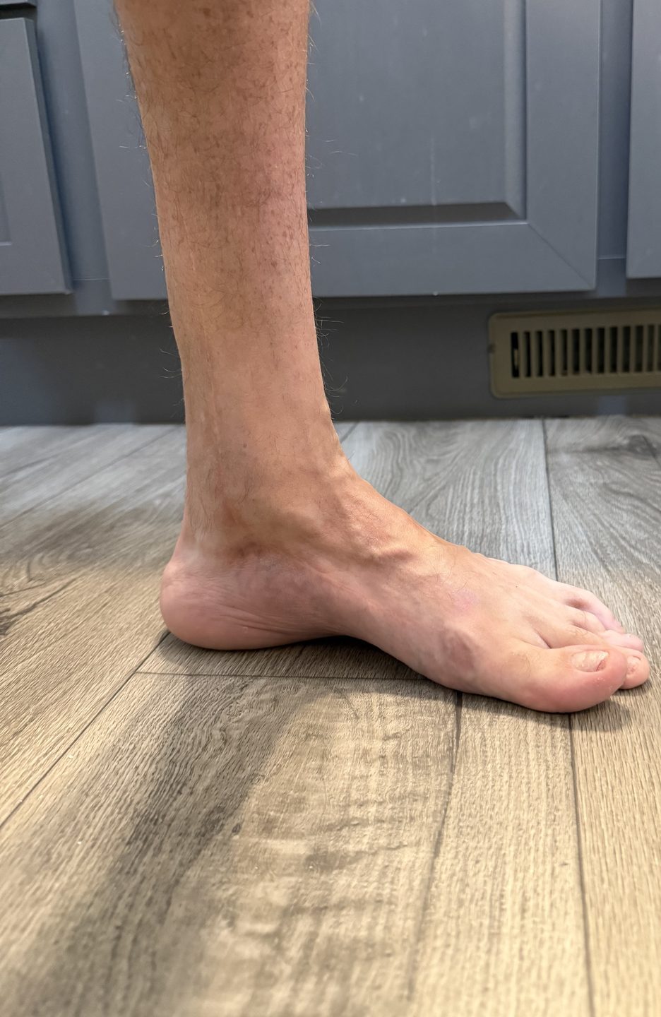 Inner side of the lower leg and foot of an adult with treated clubfoot, showing the scar running from the midfoot up toward the shin left by posteromedial release surgery in infancy.