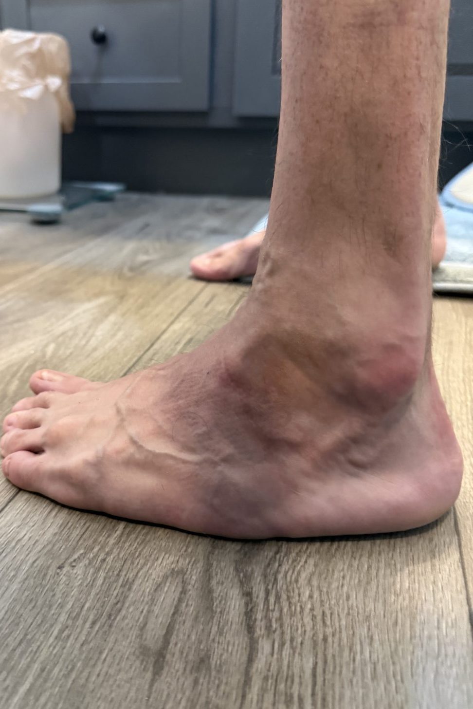 Left foot and ankle of an adult with treated clubfoot showing the surgical scar left by a triple arthrodesis performed at age sixteen.